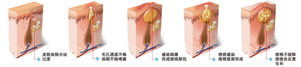 痘痘形成过程